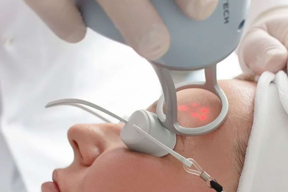 Tratamentos a Laser (Lavieen, Ultraformer) em Penha